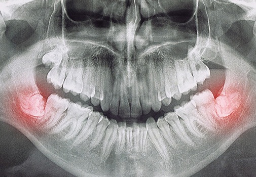 X-ray of impacted wisdom teeth