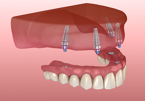 Illustration of a full denture being secured onto four dental implants throughout the jaw