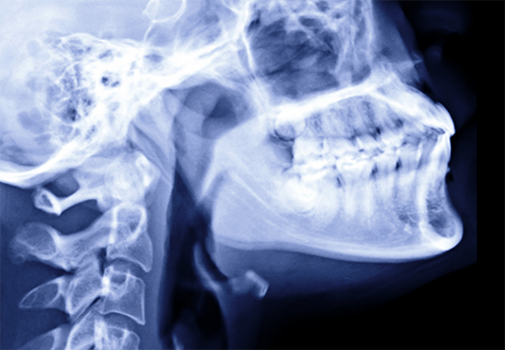 X ray of a person with All on X dental implants