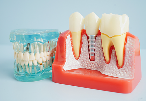 Two models of dental implants in between natural teeth