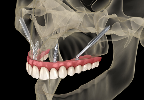 Illustrated x ray of a full upper implant denture supported by implants at diagonal angles