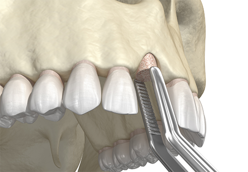 Illustration of bone grafting material being placed in the upper jawbone