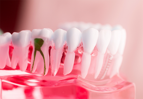 Model of the mouth with a damaged tooth