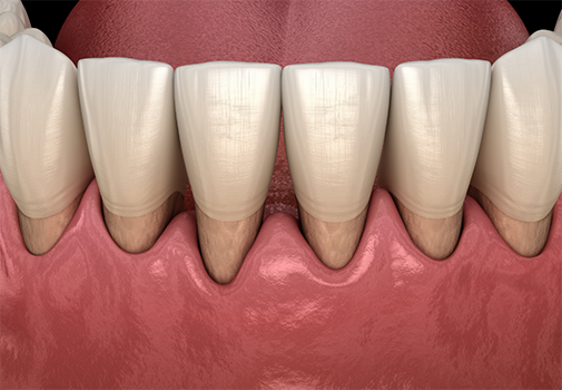Illustration of a row of teeth with a receding gumline