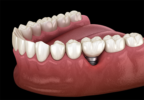 Illustration of the gums around a dental implant receding