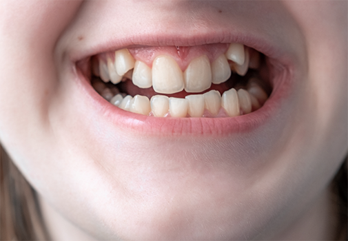 Close up of a person smiling with impacted canine teeth
