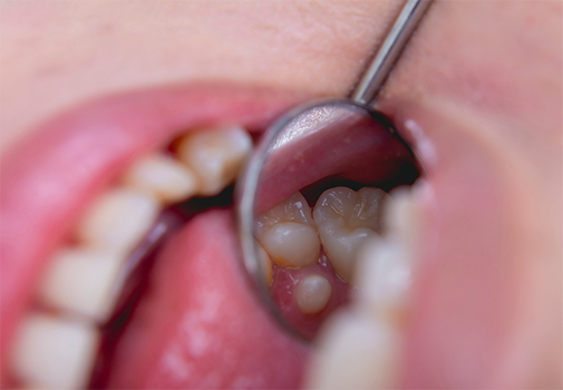 Close up of a dental mirror reflecting a mouth with extra teeth