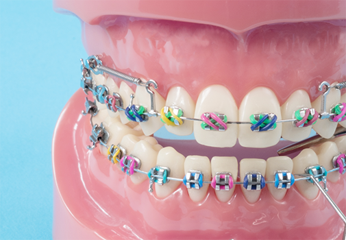 Model of the teeth with surgical screws connecting parts of the braces