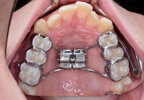 Palatal expander on the roof of a mouth