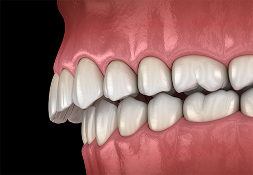 Illustration of a mouth with an overbite