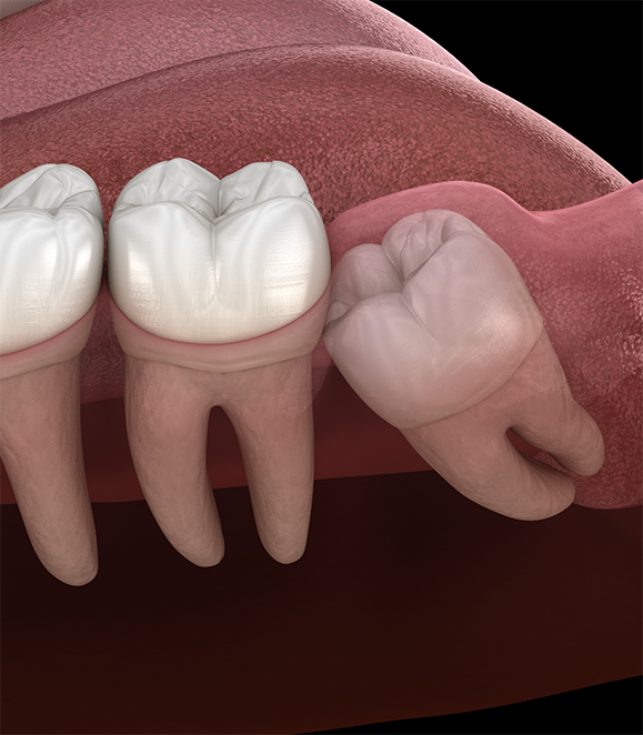 Illustration of an impacted wisdom tooth pressing against the adjacent tooth